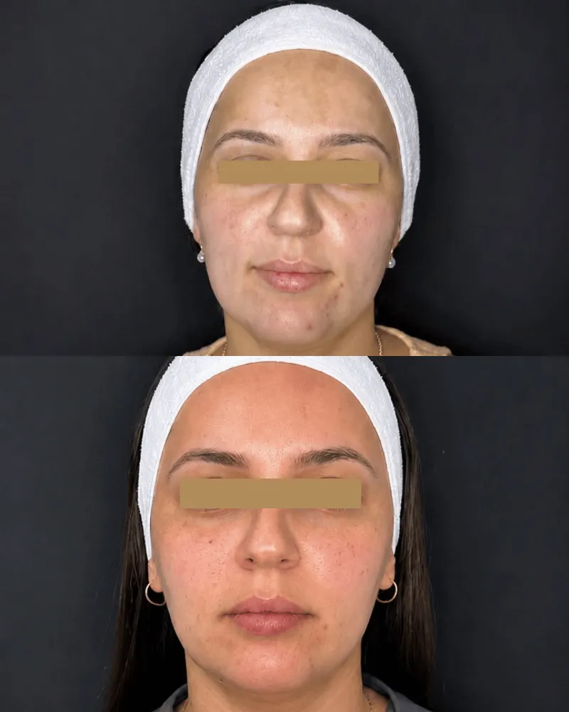 Harmonização facial: resultado de paciente da Elyssium Clinic