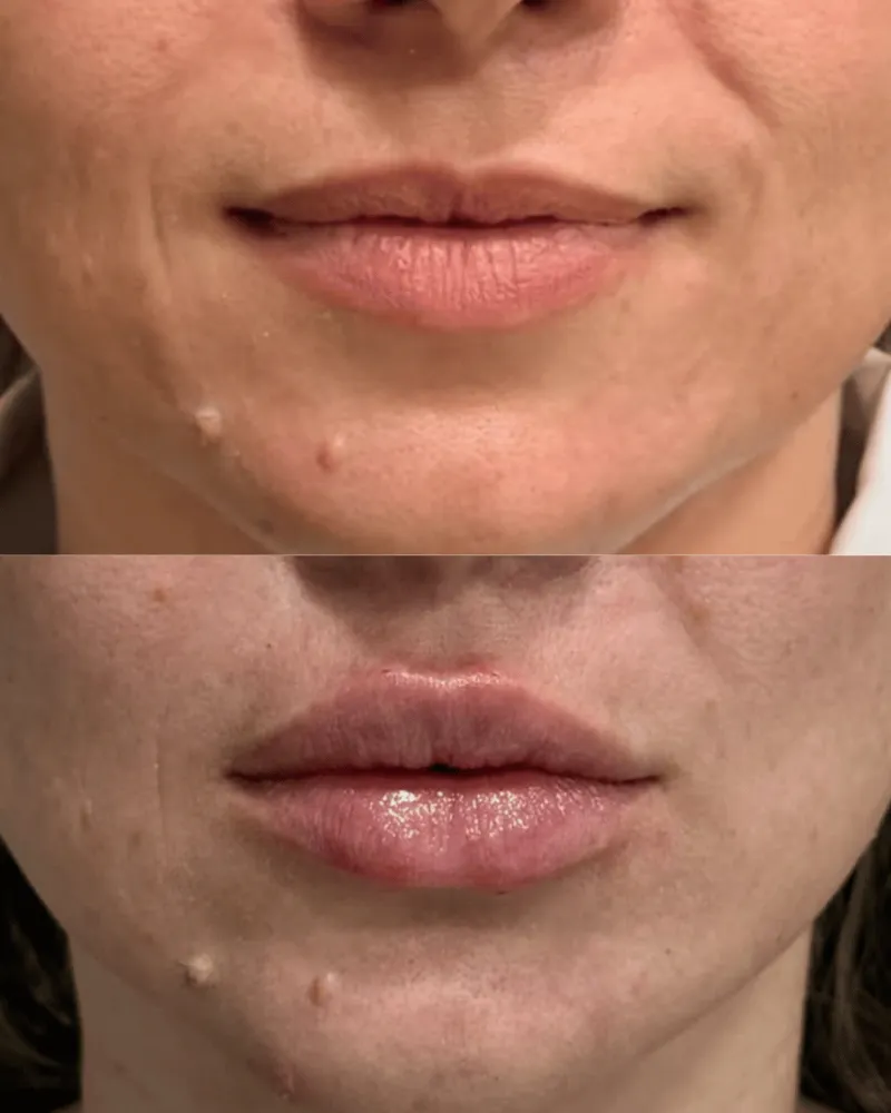 Preenchimento labial: resultado de paciente da Elyssium Clinic
