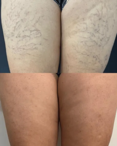 Tratamento de vasinhos: resultado de paciente da Elyssium Clinic